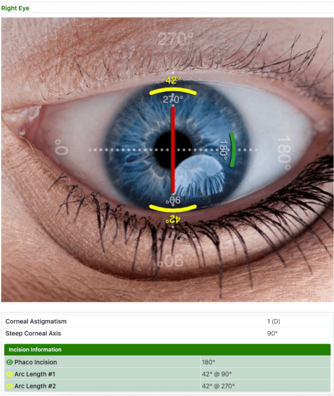 How to Use the LRI Calculator