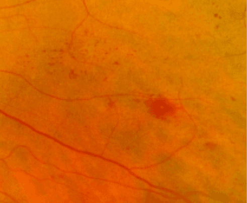 Imaging Hemes: A Case of Proliferative Diabetic Retinopathy