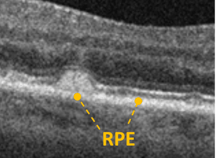 The Optometrist's Guide to Geographic Atrophy