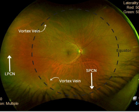 Retinal Location The OD's Guide to Identifying Peripheral Retinal Disease with Cheat Sheet