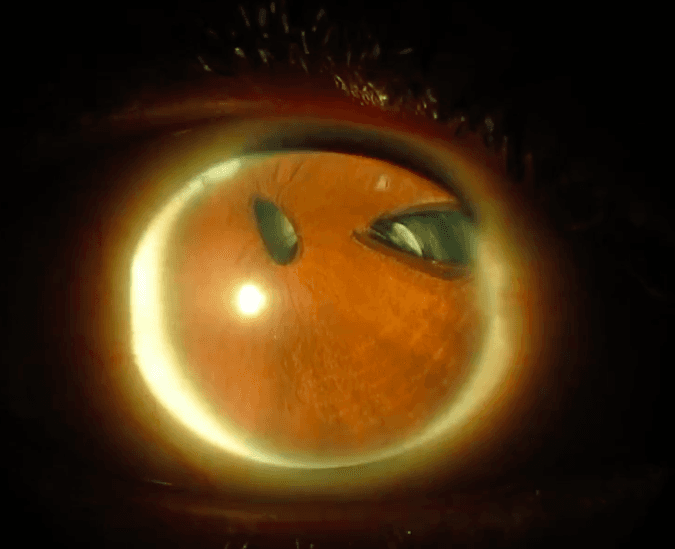 Procornea Rgp A Case Study on the Role of RGP Lenses in Management of Microcornea