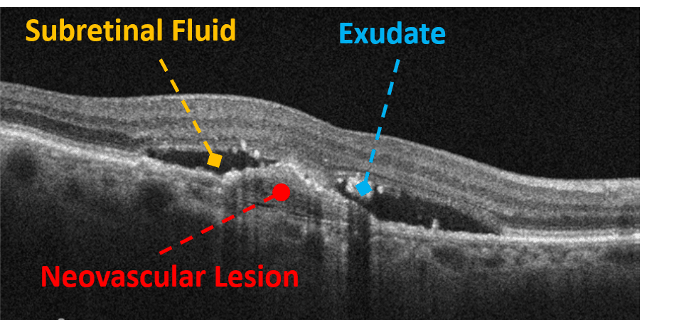 Neovascular Net On 5 Line Rastor Oct Into the Woods: Interpreting OCT Imaging in Retinal Disease