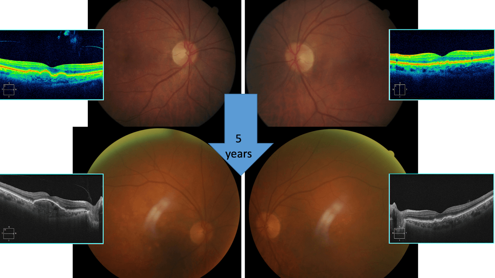 OCT Angiography: Routine to Extreme