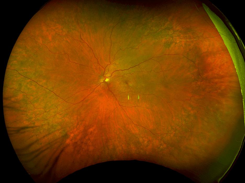The Wide Spectrum of Peripheral Retinal Disease in AMD