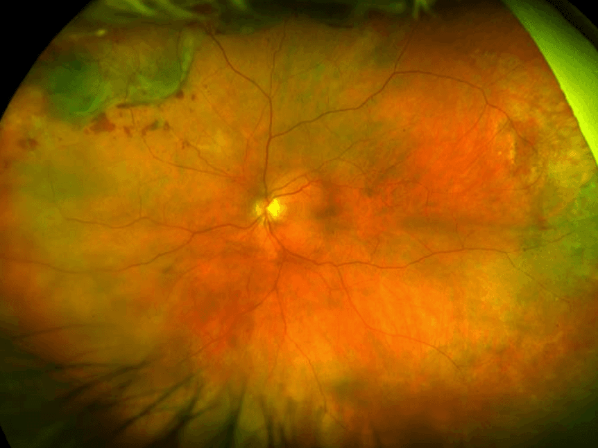 The Wide Spectrum of Peripheral Retinal Disease in AMD