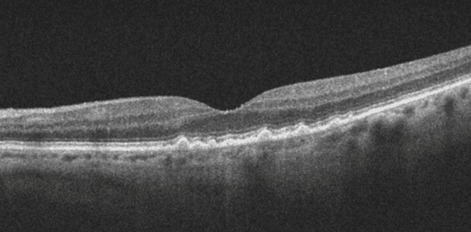 Homonymous Atrophy Oct A New Practice Pattern for Geographic Atrophy