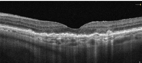 Homonymous Atrophy Oct How to Identify Geographic Atrophy Early with Multimodal Imaging