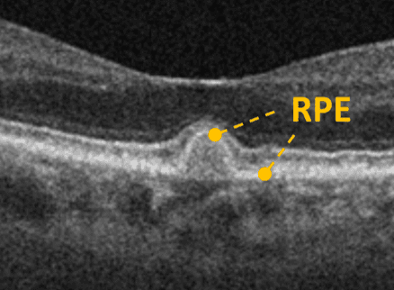 Progressive Atrophy Rpe The Optometrist's Guide to Geographic Atrophy