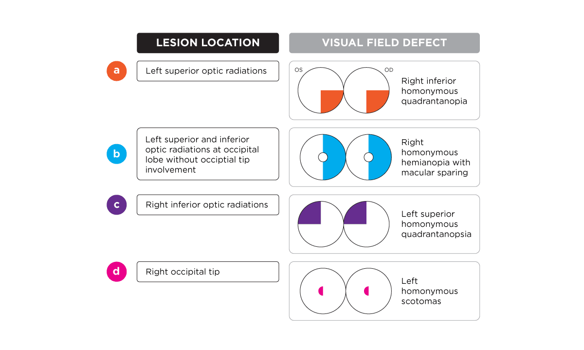 Understanding Cortical Blindness: Essential Guide for Optometrists