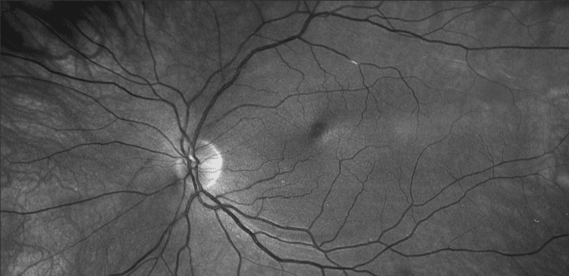Transient Visual Desaturation A Guide to Transient Vision Loss with Protocol Download