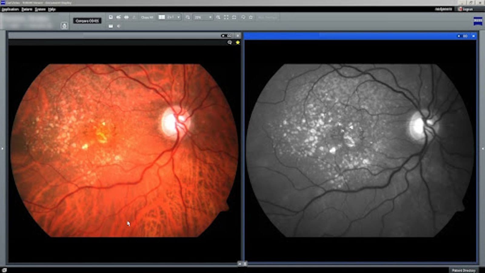 Diagnosing and Managing Retinal Disease with Integrated Diagnostics