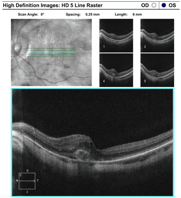 Hd 5 Line Raster Ocular Manifestations of Ehlers-Danlos Syndrome