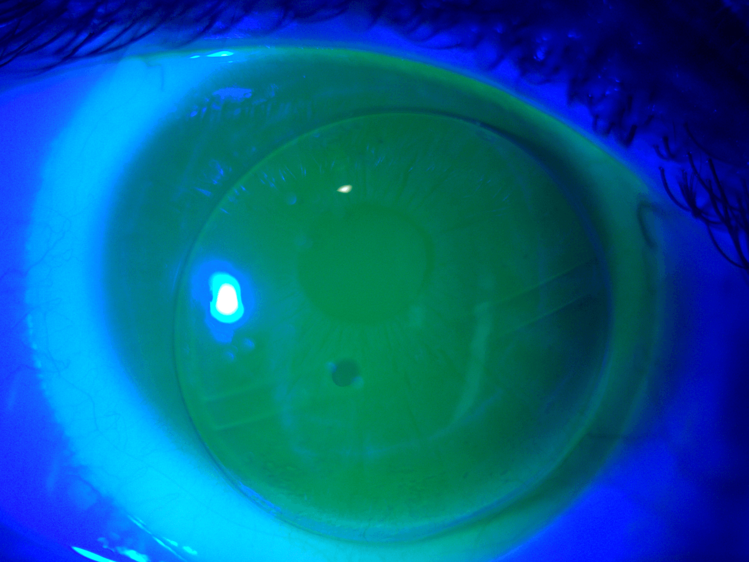 What to Know about Gas Permeable Lenses