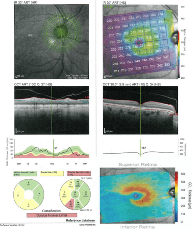 Clinical Pearls for Identifying and Managing Normal-Tension Glaucoma