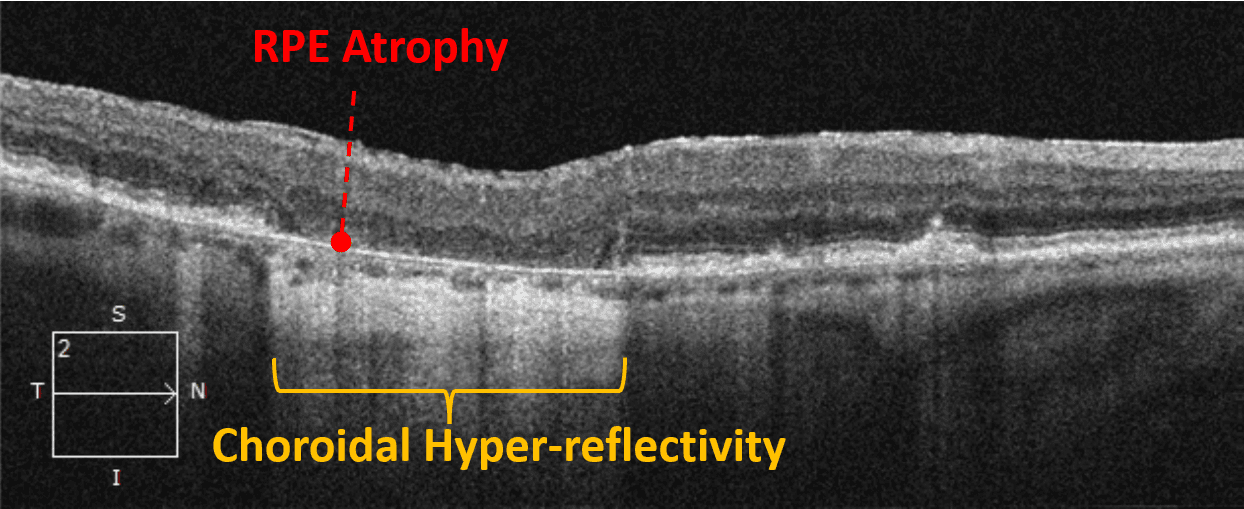 Into the Woods: Interpreting OCT Imaging in Retinal Disease