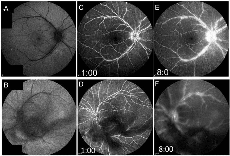 Uveitis Lab Testing Identifying Optimal Image Selection for Posterior Uveitis