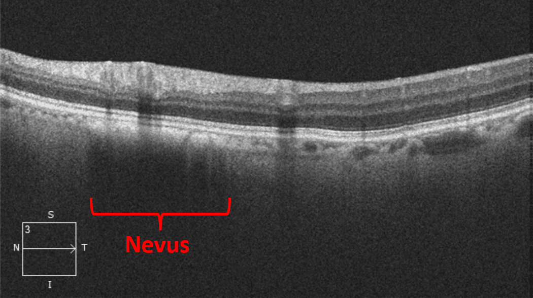 Oct Grid Into the Woods: Interpreting OCT Imaging in Retinal Disease