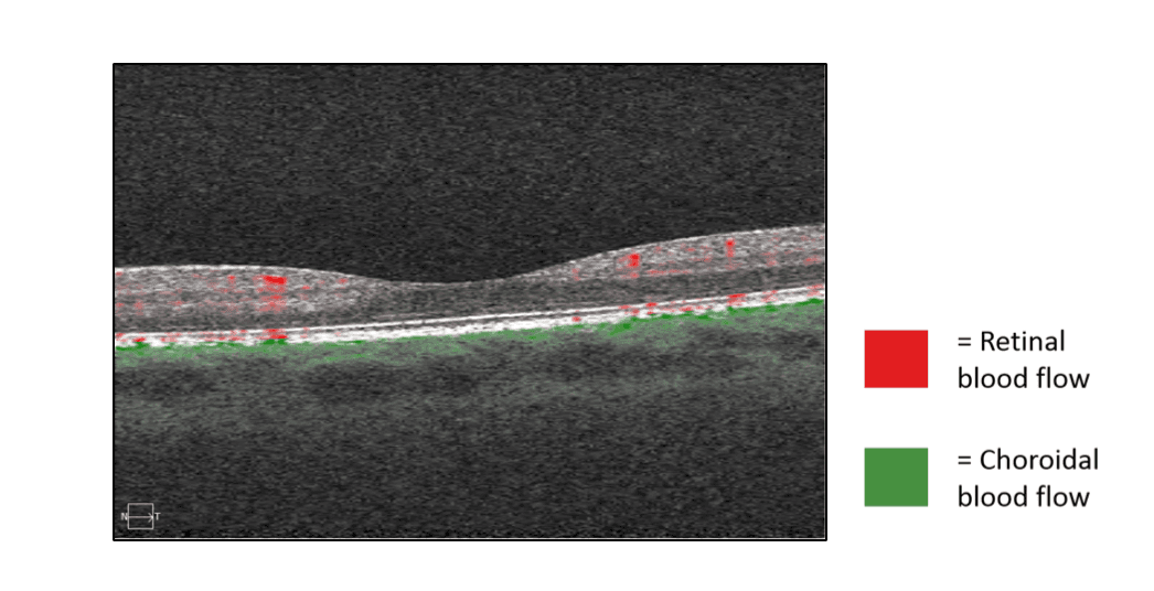 OCT Angiography: Routine to Extreme