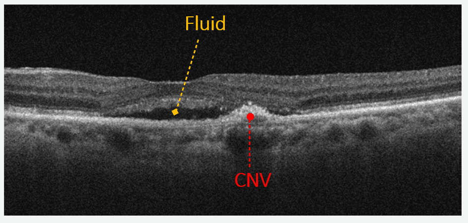 Neovascular Net On 5 Line Rastor Oct OCT Retinal Bootcamp