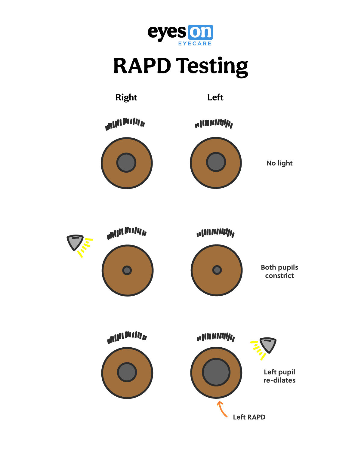 Here's the Easiest Way to Test for an Afferent Pupillary Defect