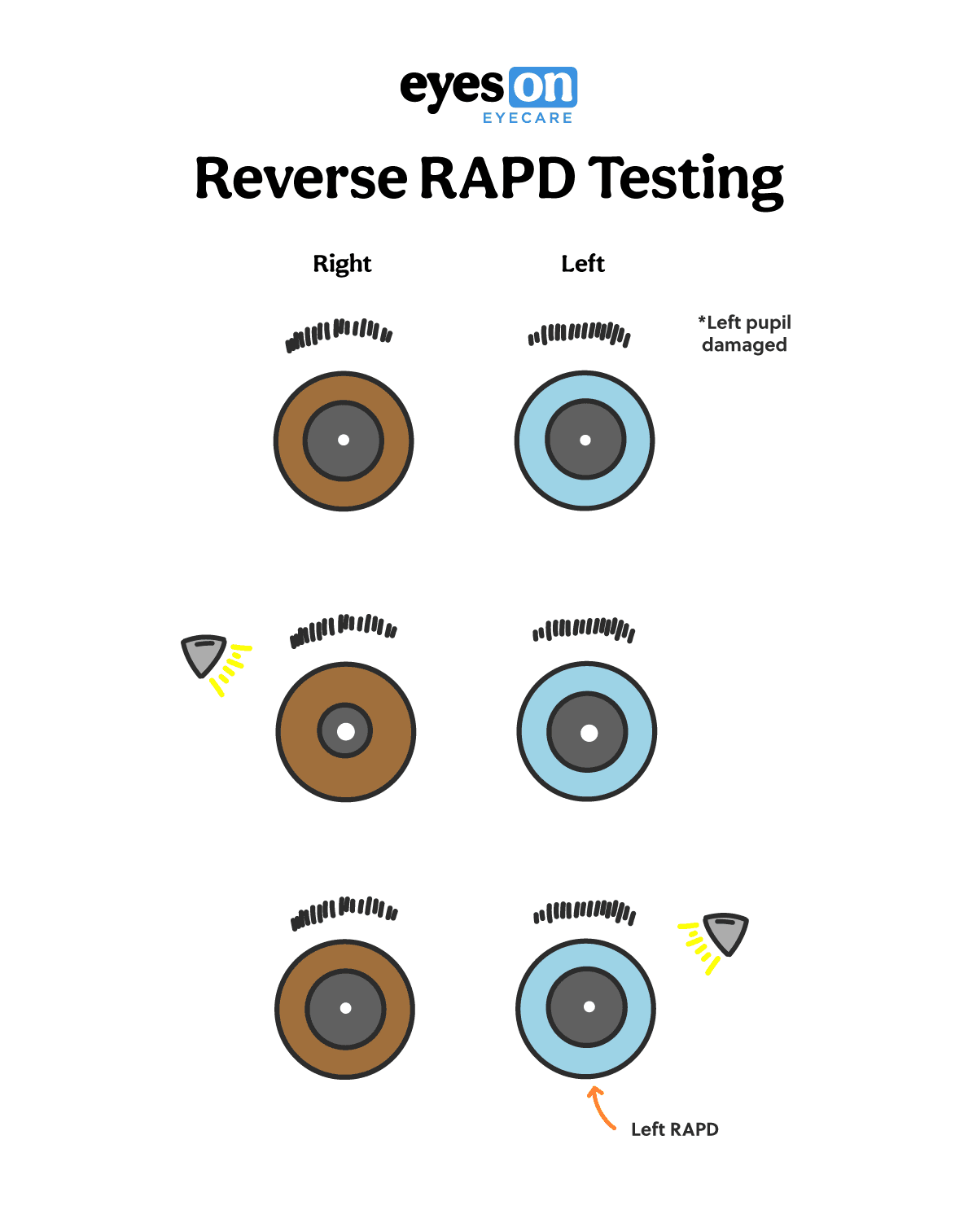 Here's the Easiest Way to Test for an Afferent Pupillary Defect