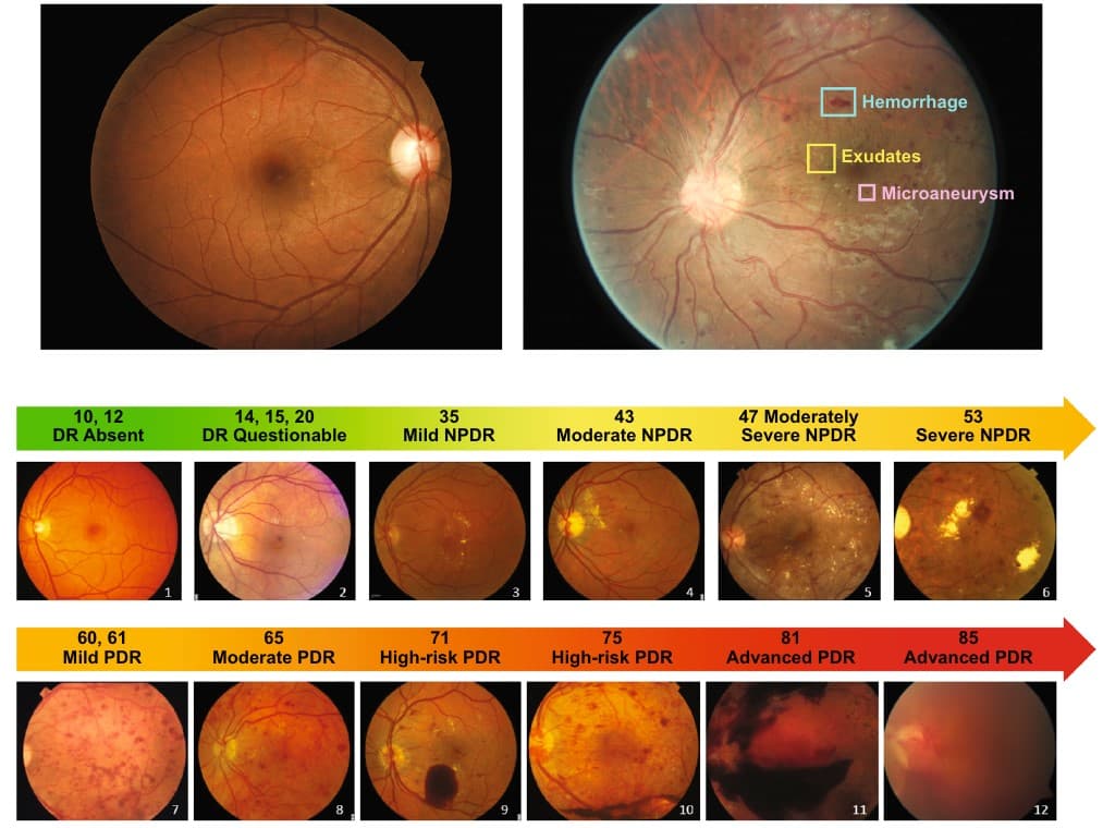 Assessing and Grading Diabetic Retinopathy: Updates for Ophthalmology ...
