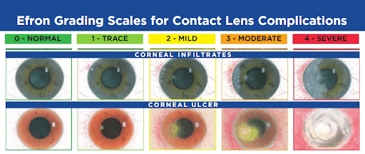 Using Antimicrobial Contact Lenses to Reduce Corneal Infections