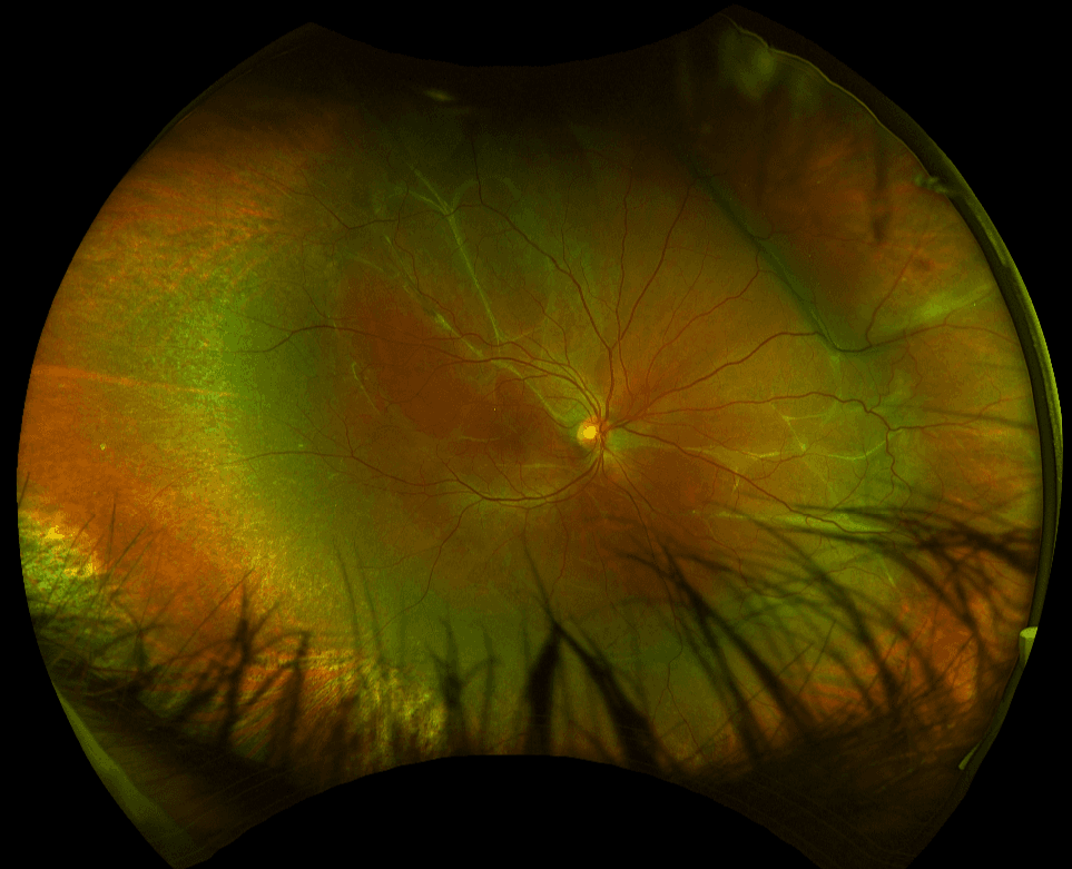 Retinal Band What Ophthalmology Residents Should Know About Retinal Detachment Repair