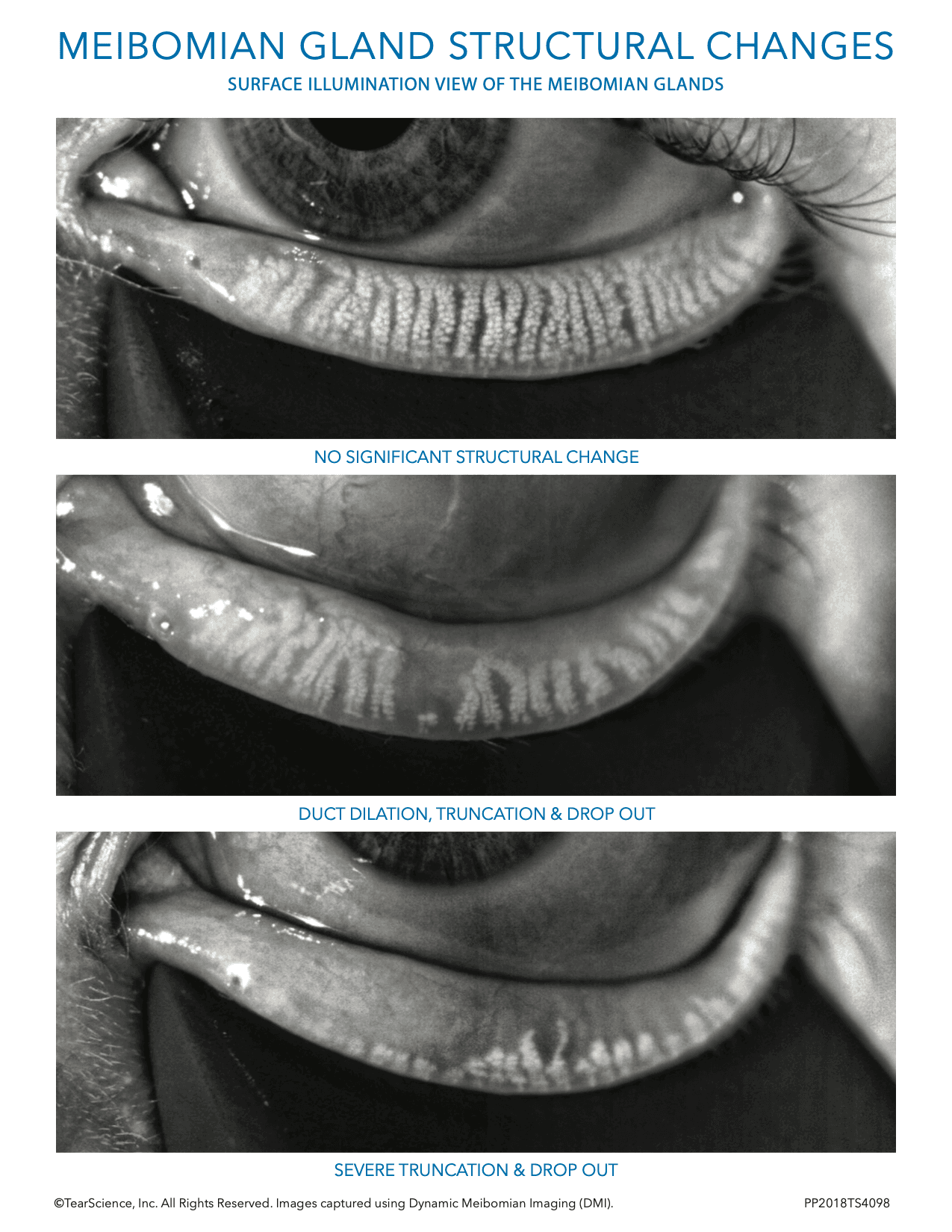 Treating Meibomian Gland Dysfunction With Collaborative Care treating-meibomian-gland-dysfunction-with-collaborative-care