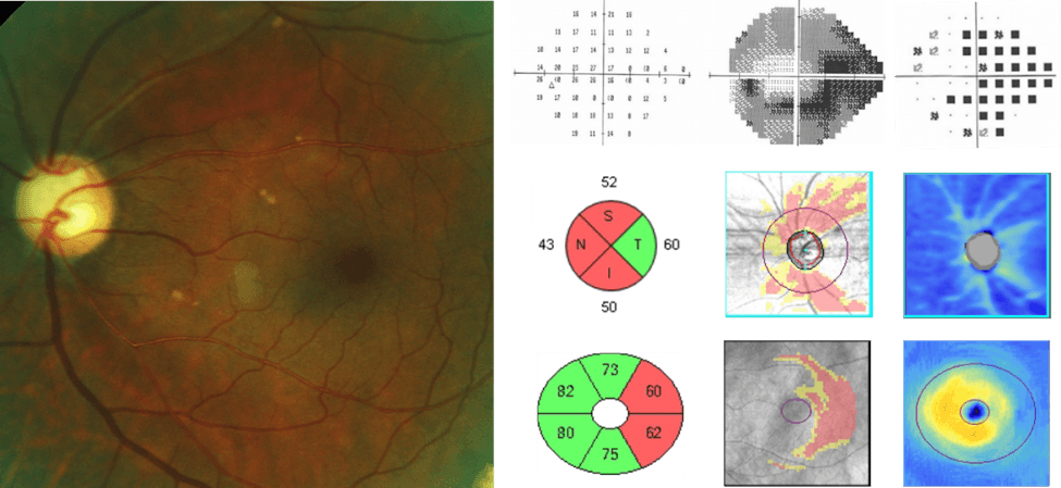 Utilizing OCT for Glaucoma Diagnosis and Management