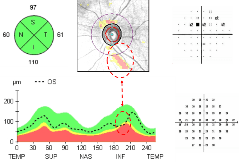 Utilizing OCT for Glaucoma Diagnosis and Management