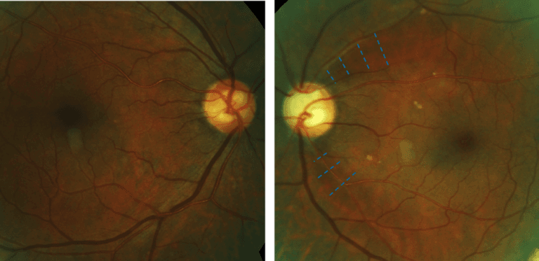 Utilizing OCT for Glaucoma Diagnosis and Management