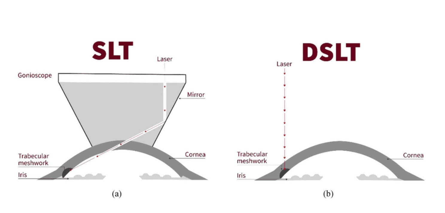 New and Upcoming Developments in Glaucoma Treatment