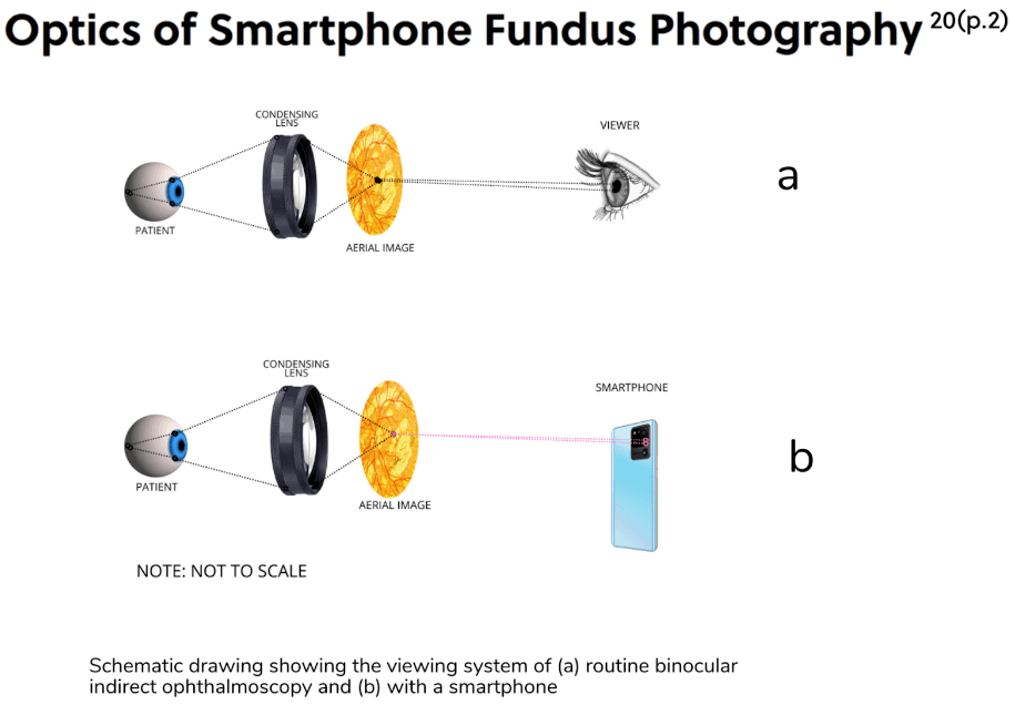 Fundus Capture How to Use a Smartphone for Fundus Photography to Capture Quality ...