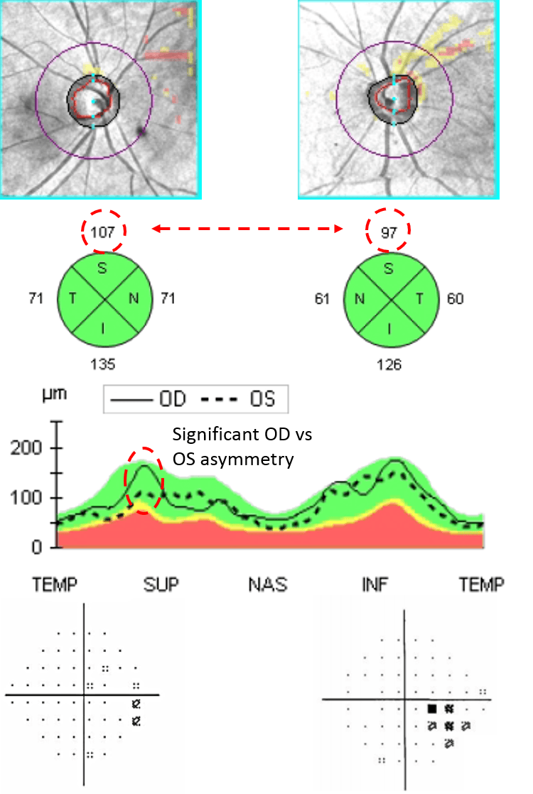 Utilizing OCT for Glaucoma Diagnosis and Management
