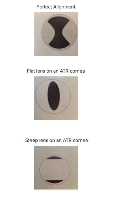 Atr Rgp Lens Fitting A Quick and Easy Reference Guide to Troubleshooting RGP Lenses
