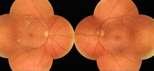 Topcon Scan Pattern 5 Clinical Uses for the Topcon Maestro 3D OCT