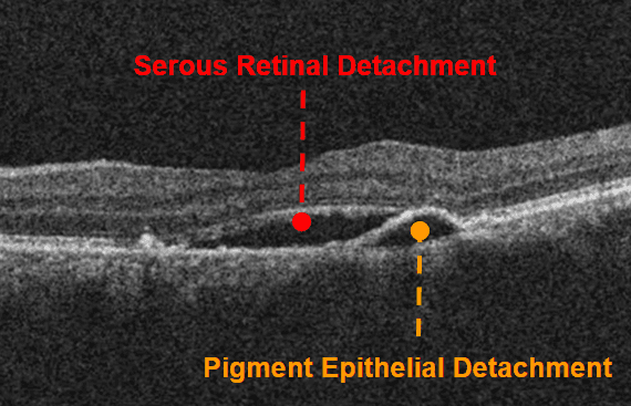 Oct Disesses A Complete List of Ocular Diseases with Optical Coherence Tomography (OCT)