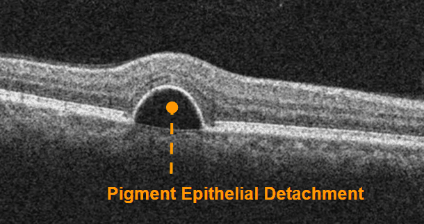 A Complete List of Ocular Diseases with Optical Coherence Tomography (OCT)
