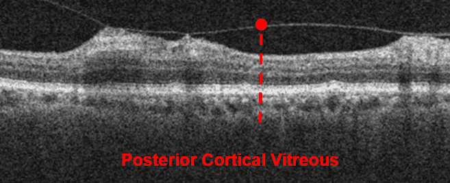 A Complete List of Ocular Diseases with Optical Coherence Tomography (OCT)