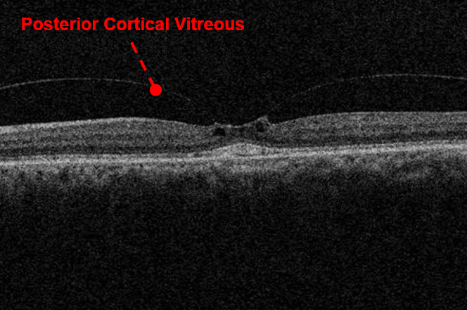A Complete List of Ocular Diseases with Optical Coherence Tomography (OCT)