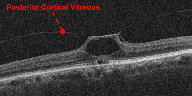 A Complete List of Ocular Diseases with Optical Coherence Tomography (OCT)
