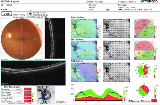 Topcon Scan Pattern 5 Clinical Uses for the Topcon Maestro 3D OCT