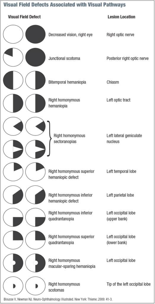 Investigating Unexplained Reduced Visual Acuity