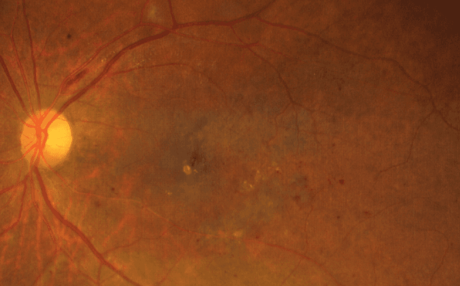 Clarus Normal Real World Experience with the ZEISS CLARUS 500