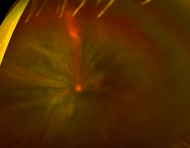 PIVB retinal detachment