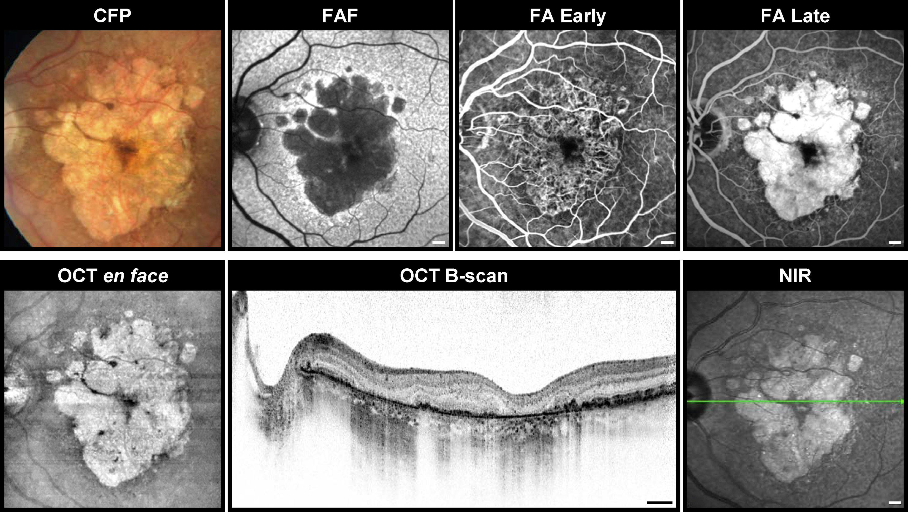 Geographic Atrophy OCT and FA Imaging