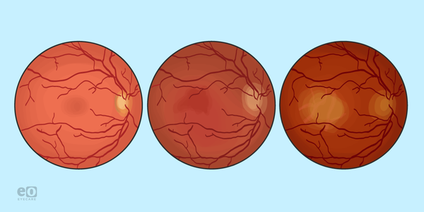 What Macular Degeneration to Geographic Atrophy Progression Really Looks Like