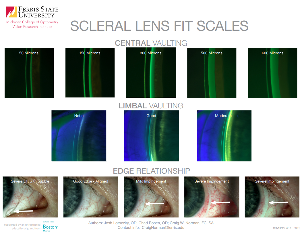 Scleral lens fit scales