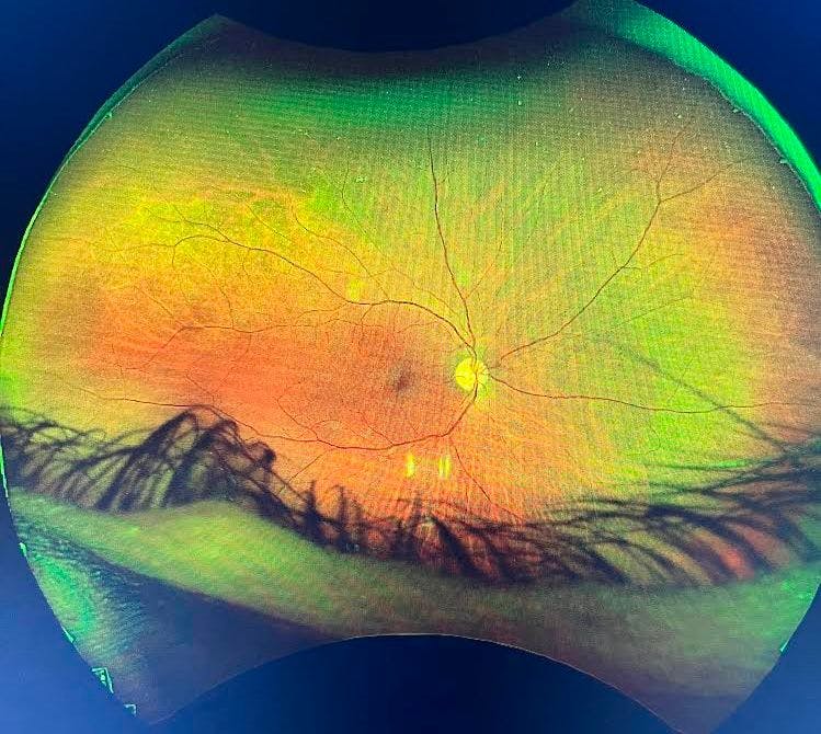 Severe non-proliferative diabetic retinopathy Fundus OD